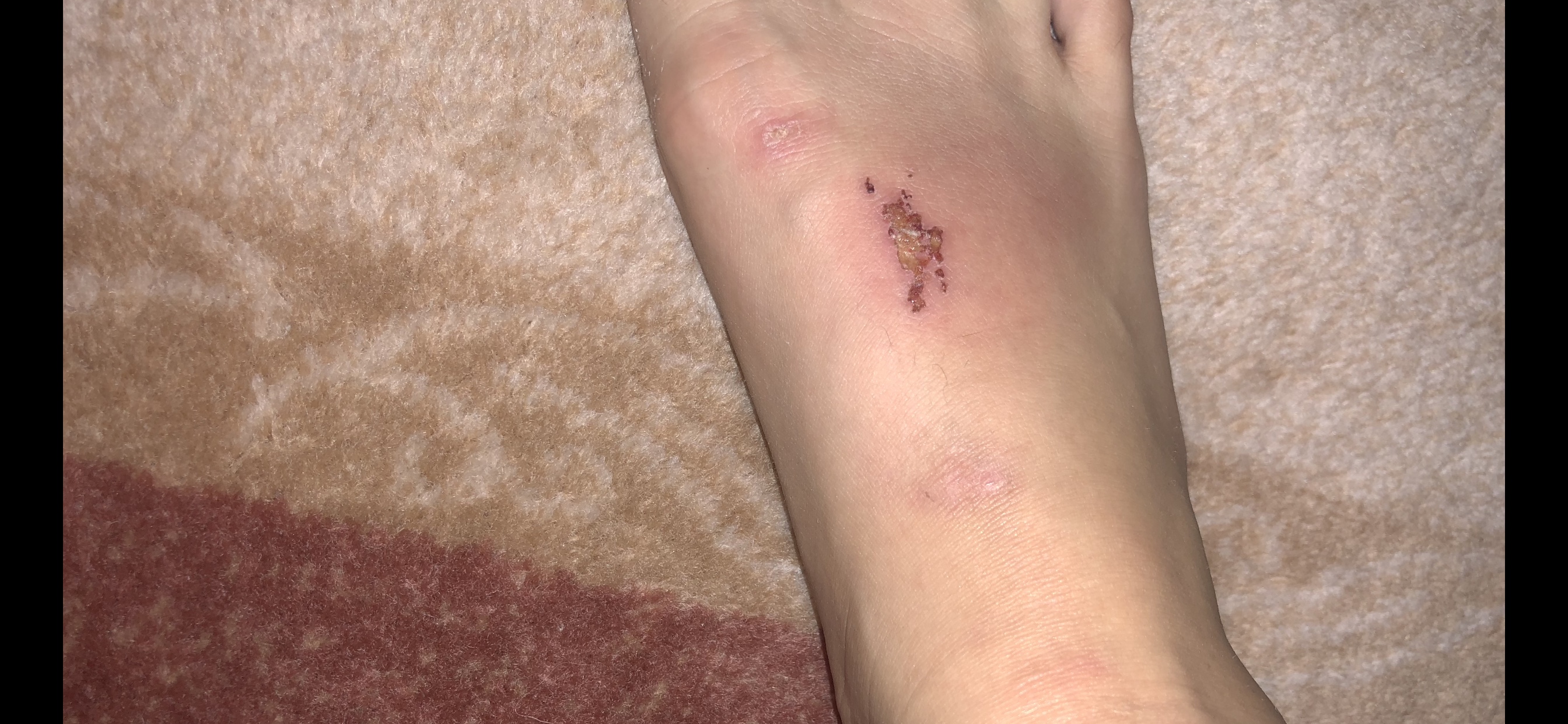 Courtesy: Anna Kostenko. 
(Anna's foot after a training session)